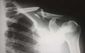 Shoulder X-Ray.